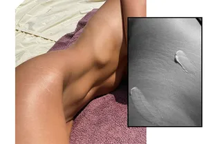 Почему появляются растяжки и можно ли избавиться от них навсегда