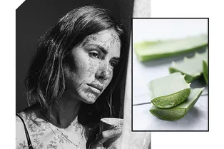 Самые эффективные натуральные средства для экстренного избавления от акне